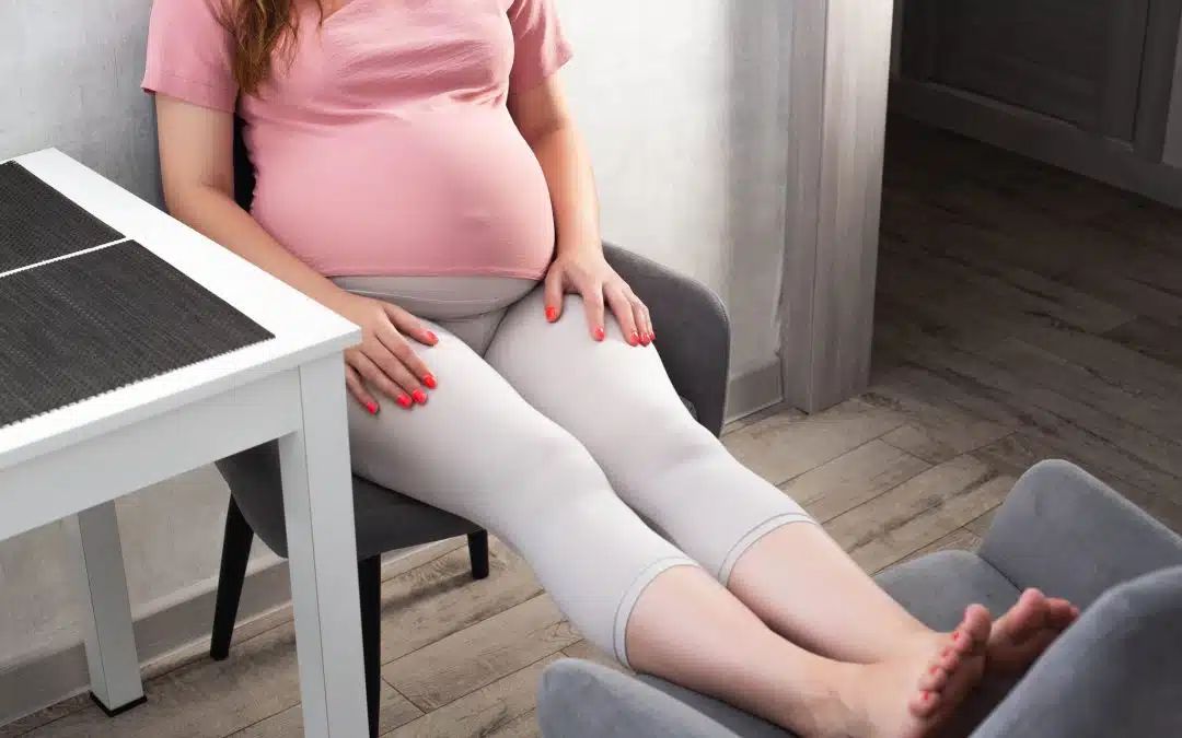 Varicose Veins After Pregnancy: Understanding Causes, Treatment, and Prevention