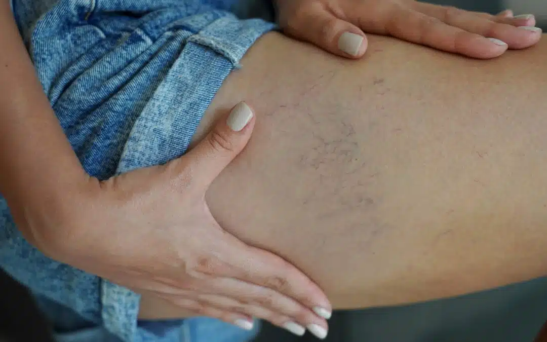 Revolutionizing Vascular Aesthetics with Sclerotherapy for Spider and Varicose Veins