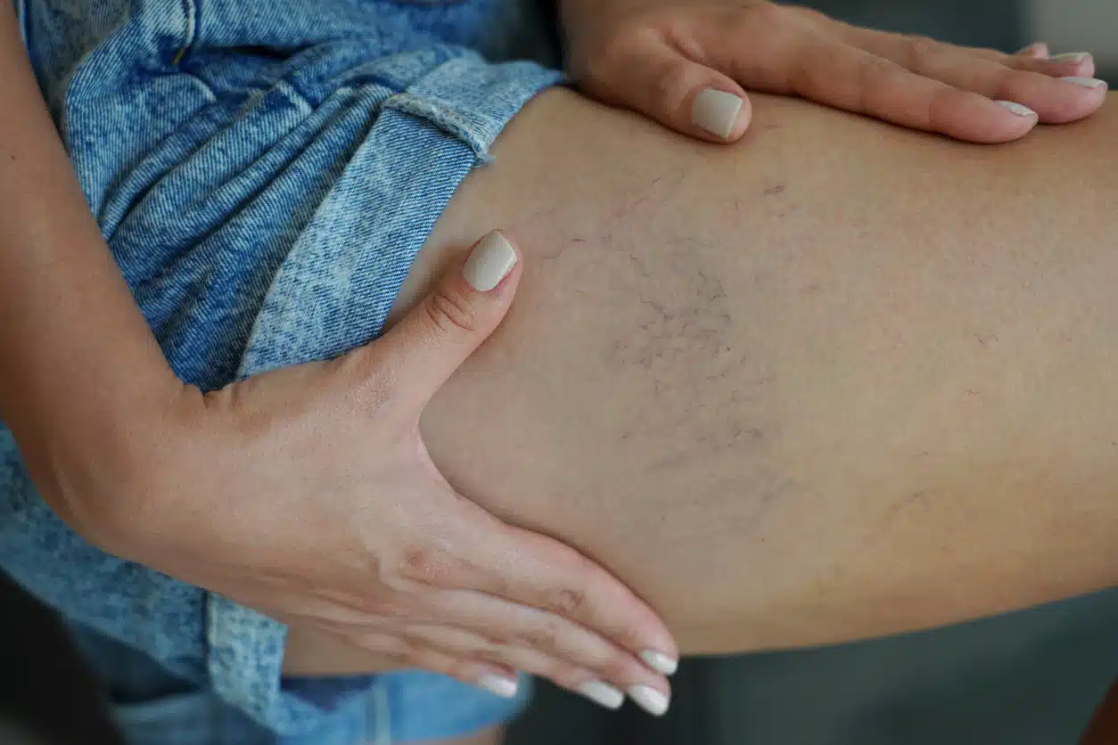 Sclerotherapy for Spider and Varicose Veins