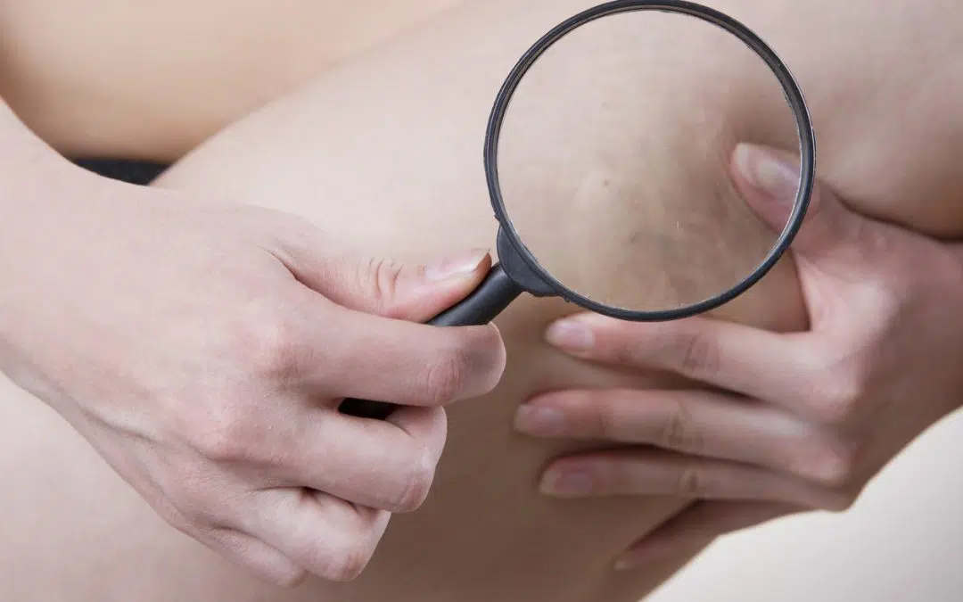 Unmasking Varicose & Spider Veins: Types, Treatments, and The Road to Relief