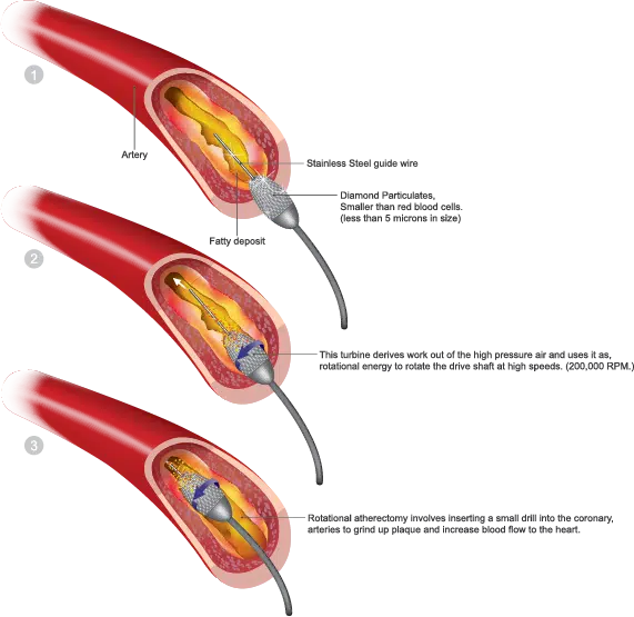Atherectomy Procedure
