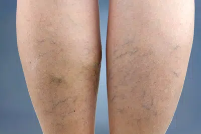 Spider Veins