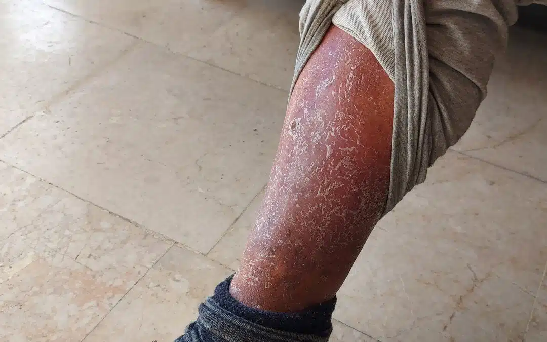 Understanding the Link Between Venous Ulcers and Venous Insufficiency