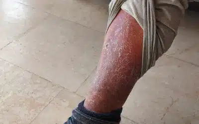 Understanding the Link Between Venous Ulcers and Venous Insufficiency