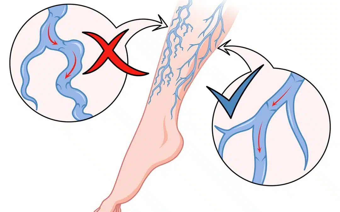 The Best Treatment for Venous Insufficiency: Getting Your Blood Flow Back on Track