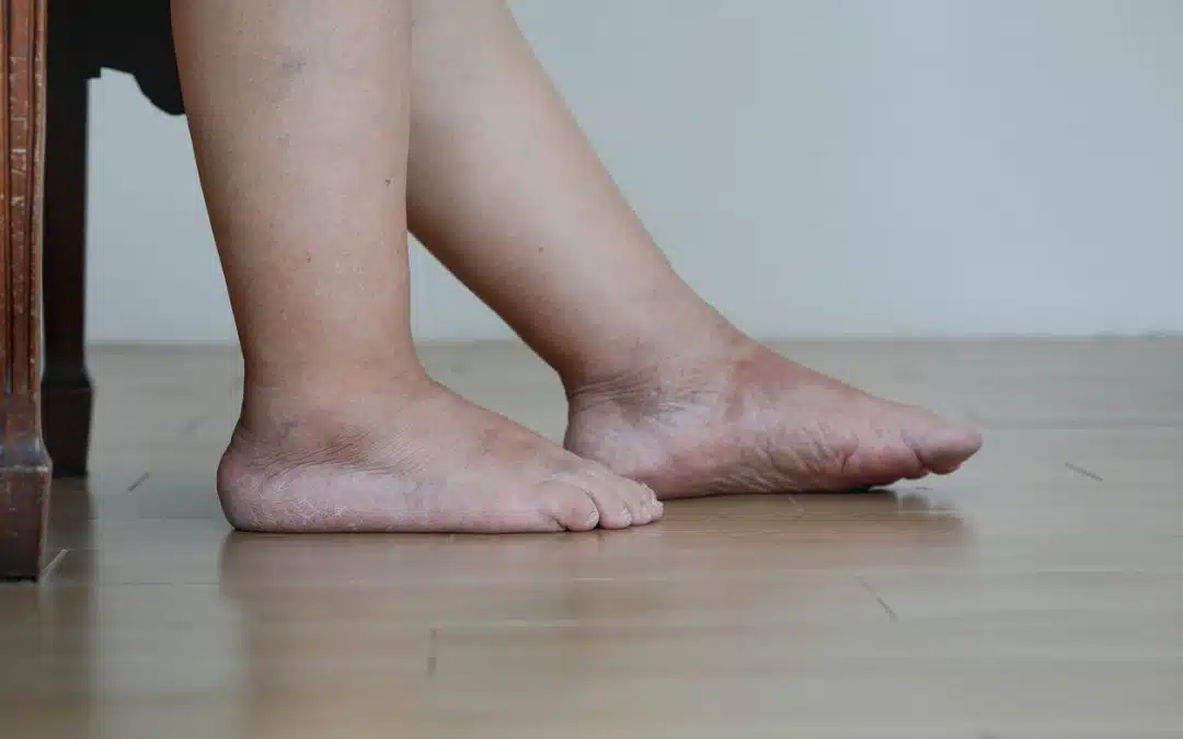 Swelling and Redness in Your Leg: Why It’s Time to Call Coastal Vascular Center