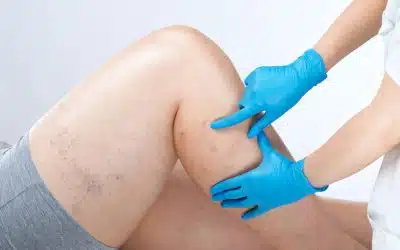 Understanding Causes of Skin Discoloration On Legs