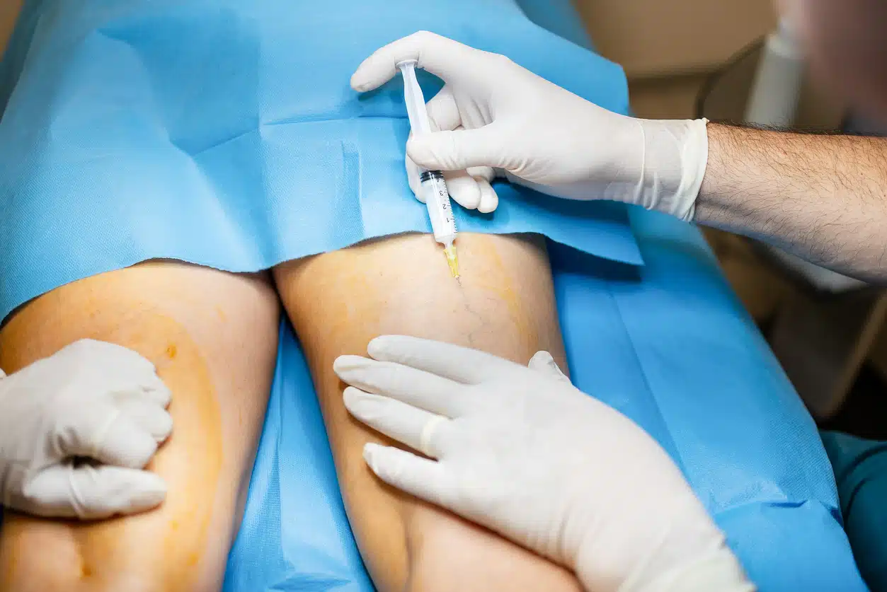 Sclerotherapy procedure