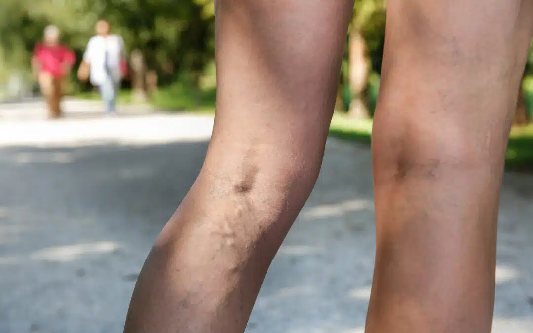 What to Expect After Sclerotherapy: Recovery & Aftercare Tips
